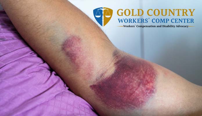 Sacramento Workers Comp Lawyer